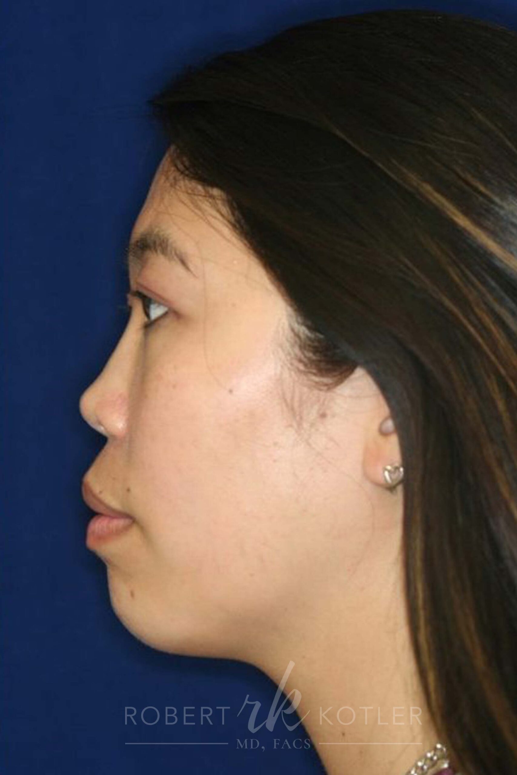 Permanent non-surgical rhinoplasty - Left Profile - After Pic - Permanent filler - Pre-injury appearance restored - Best Nose Job Surgeon