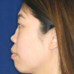 Permanent non-surgical rhinoplasty - Left Profile - Before Pic - Permanent filler - Pre-injury appearance restored - Nose Job in Beverly Hills