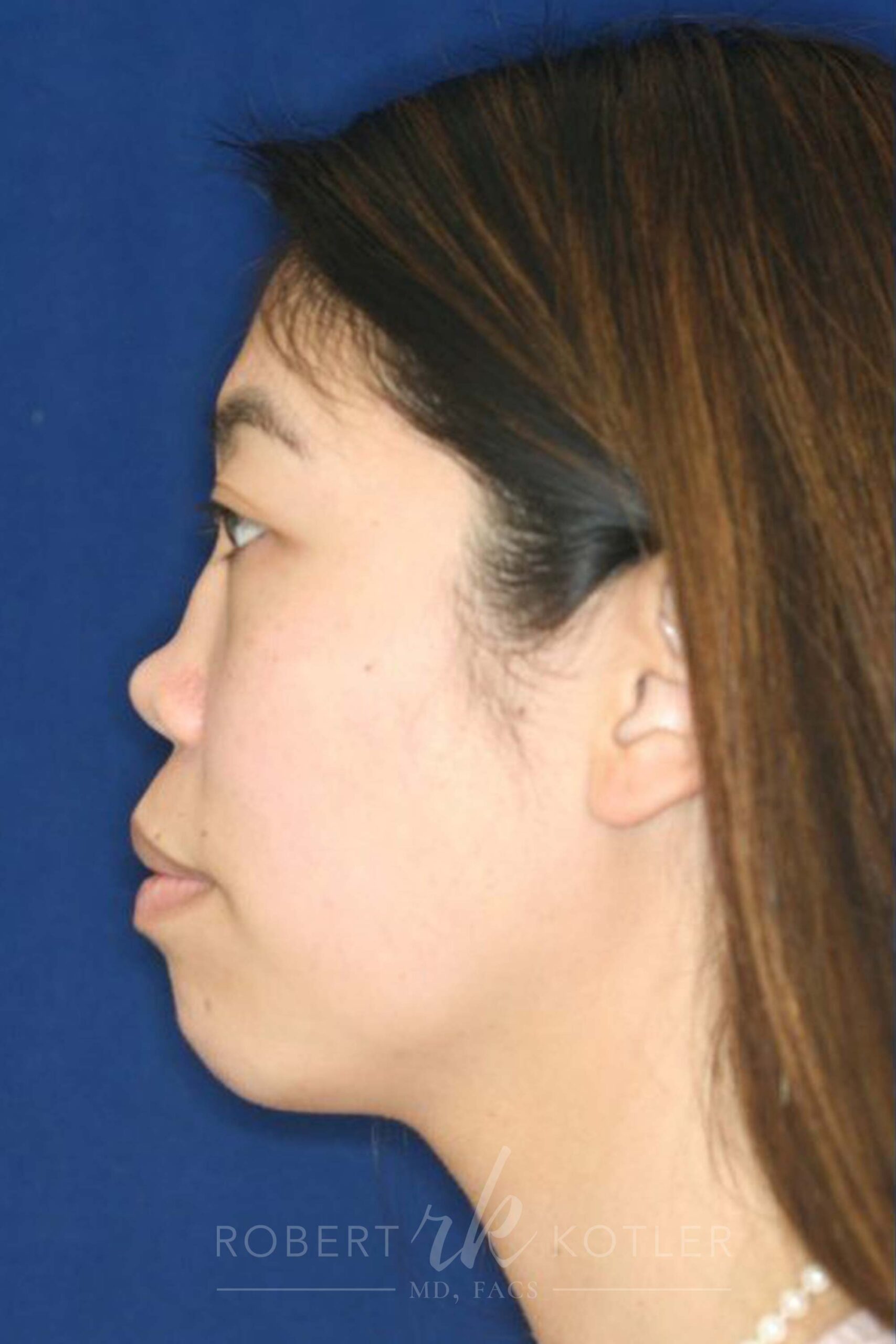 Permanent non-surgical rhinoplasty - Left Profile - Before Pic - Permanent filler - Pre-injury appearance restored - Nose Job in Beverly Hills