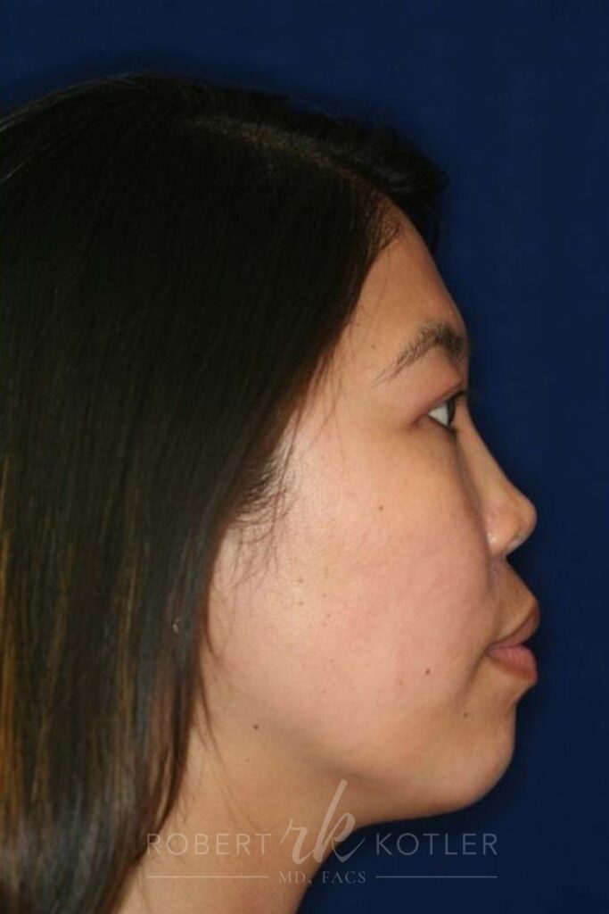 Permanent non-surgical rhinoplasty - Right Profile - After Pic - Permanent filler - Pre-injury appearance restored - Beverly Hills Rhinoplasty Superspecialist