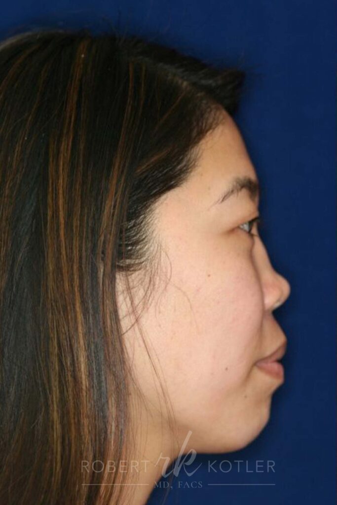 Permanent non-surgical rhinoplasty - Right Profile - Before Pic - Permanent filler - Pre-injury appearance restored - Top Rhinoplasty Surgeon