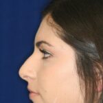 Closed Rhinoplasty - Left Profile - Before Pic - Hump removal - Tip refinement - Sculpture of nose tip angle - Rhinoplasty Surgeon in Beverly Hills