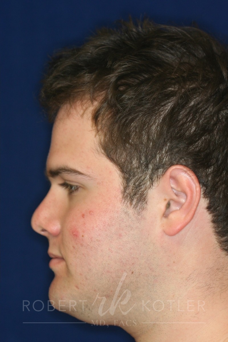 Closed Rhinoplasty - Left Profile - After Pic - Hump removal - Nose tip refinement - Best Rhinoplasty Beverly Hills