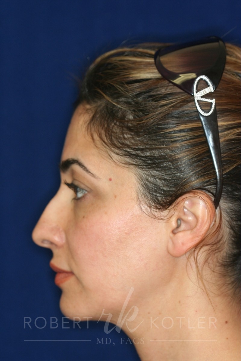Closed Rhinoplasty - Hump Removal, refined tip, nose elevated from lip - Left Profile - Before Pic - Top Rhinoplasty Surgeon