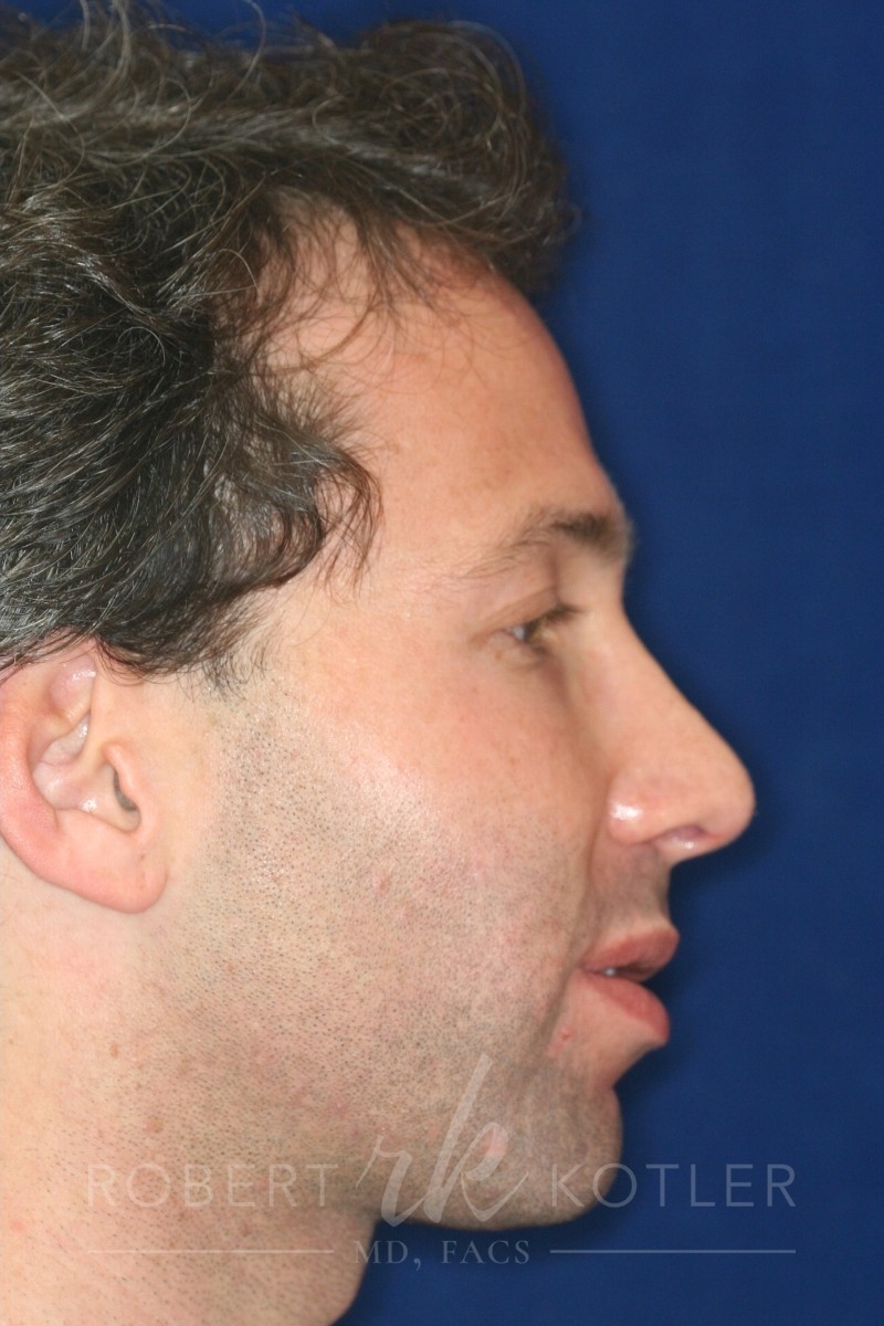 Closed Rhinoplasty - Right Profile - After Pic - Hump Removal - Tip refinement - nose elevated from lip - Beverly Hills Rhinoplasty Superspecialist