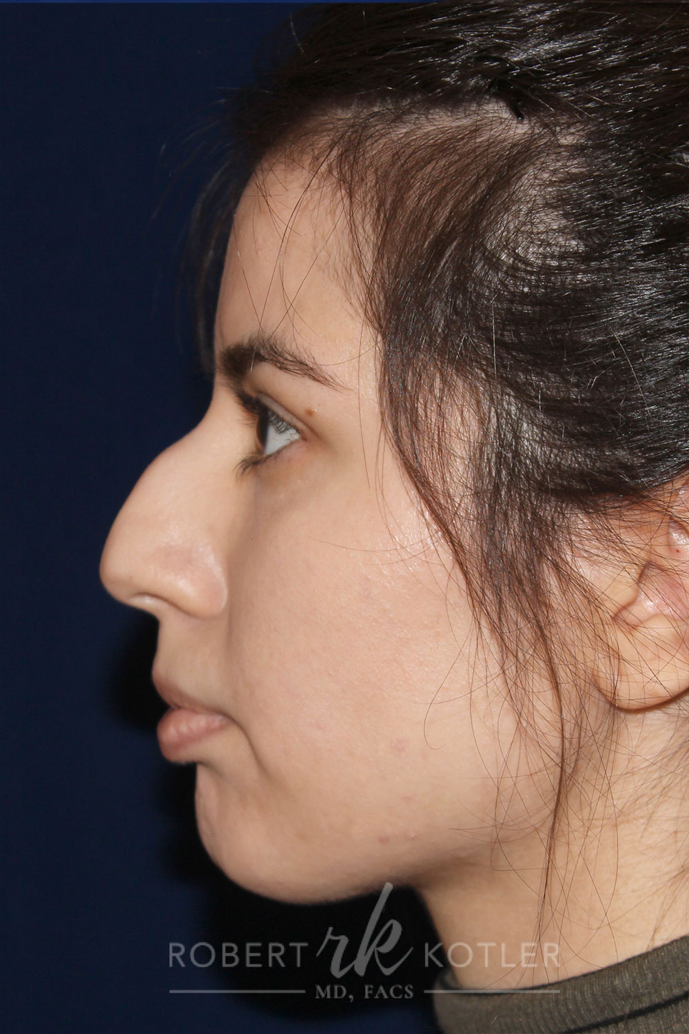 Closed Rhinoplasty - Left Profile - Before Pic - Hump removal - tip refinement - nose recessed closer to face - Rhinoplasty Surgeon in Beverly Hills