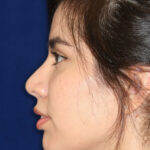 Closed Rhinoplasty - Left Profile - After Pic - Hump removal - tip refinement - nose recessed closer to face - Nose Job in Beverly Hills