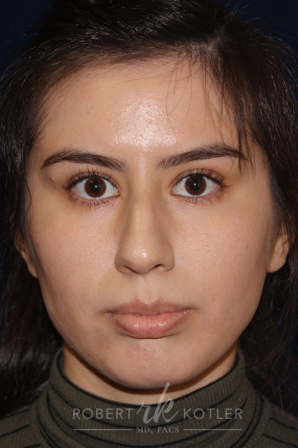 Closed Rhinoplasty - Front Face View - Before Pic - Hump removal - tip refinement - nose recessed closer to face - Best Nose Job Surgeon