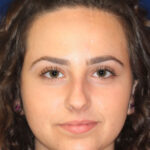 Closed Rhinoplasty - Front Face View -After Pic - Crooked nose correction - Hump removal - Recession of nose closer to face - Nose Job in Beverly Hills