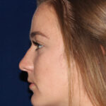 Closed Rhinoplasty - Left Profile - Before Pic - Hump removal - tip refinement - narrowing of bone - Best Nose Job Surgeon