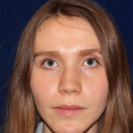 Rhinoplasty - Front Face View - Before Pic - Narrowing of the nose - narrowing of bony and cartilaginous structure - Best Nose Job Surgeon