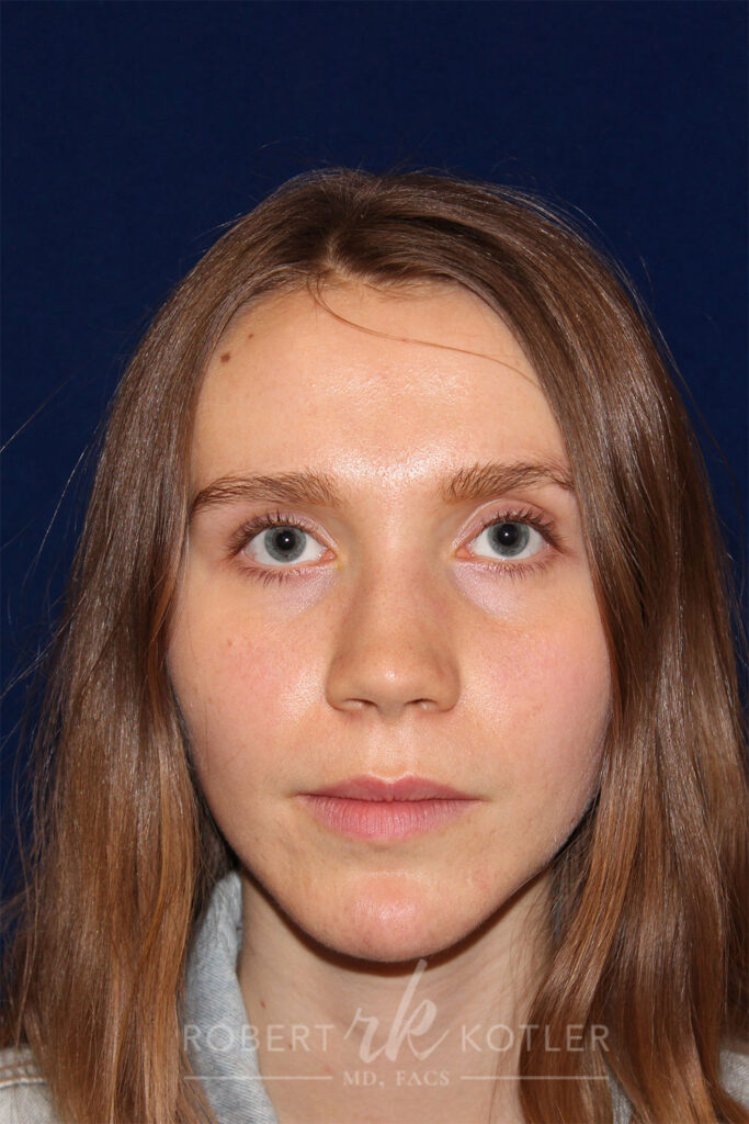 Rhinoplasty - Front Face View - Before Pic - Narrowing of the nose - narrowing of bony and cartilaginous structure - Best Nose Job Surgeon