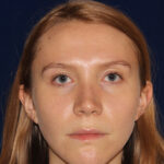 Rhinoplasty - Front Face View - After Pic - Narrowing of the nose - narrowing of bony and cartilaginous structure - Top Rhinoplasty Surgeon