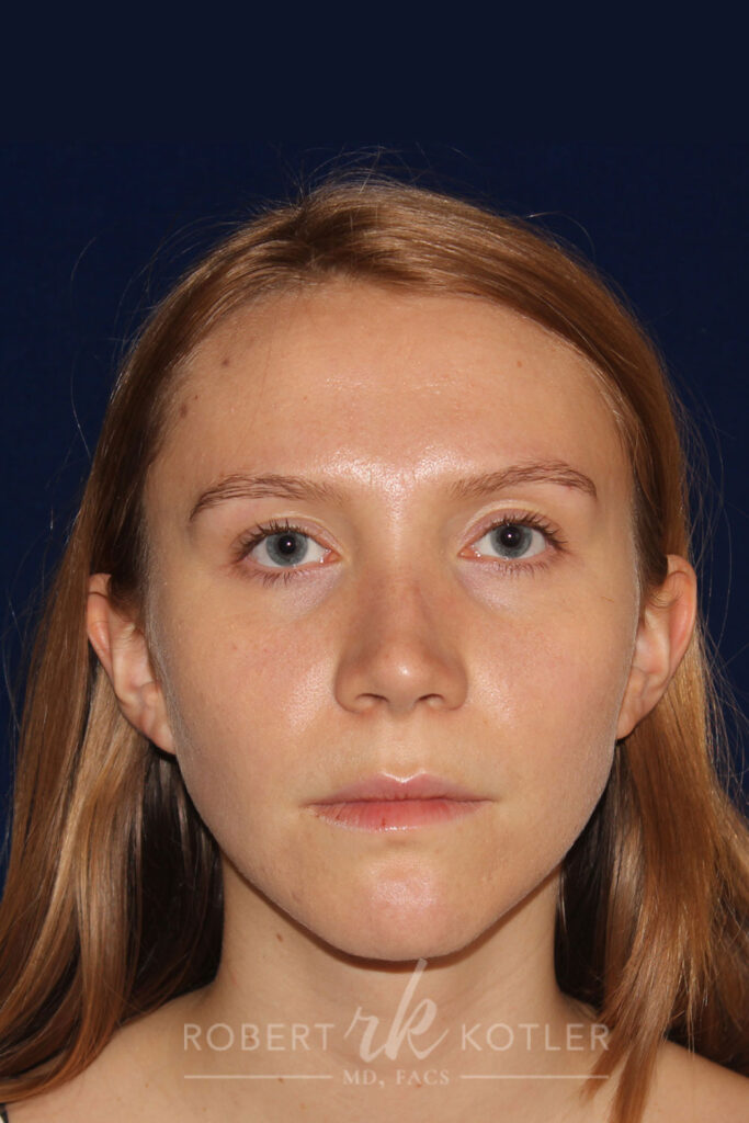 Rhinoplasty - Front Face View - After Pic - Narrowing of the nose - narrowing of bony and cartilaginous structure - Top Rhinoplasty Surgeon