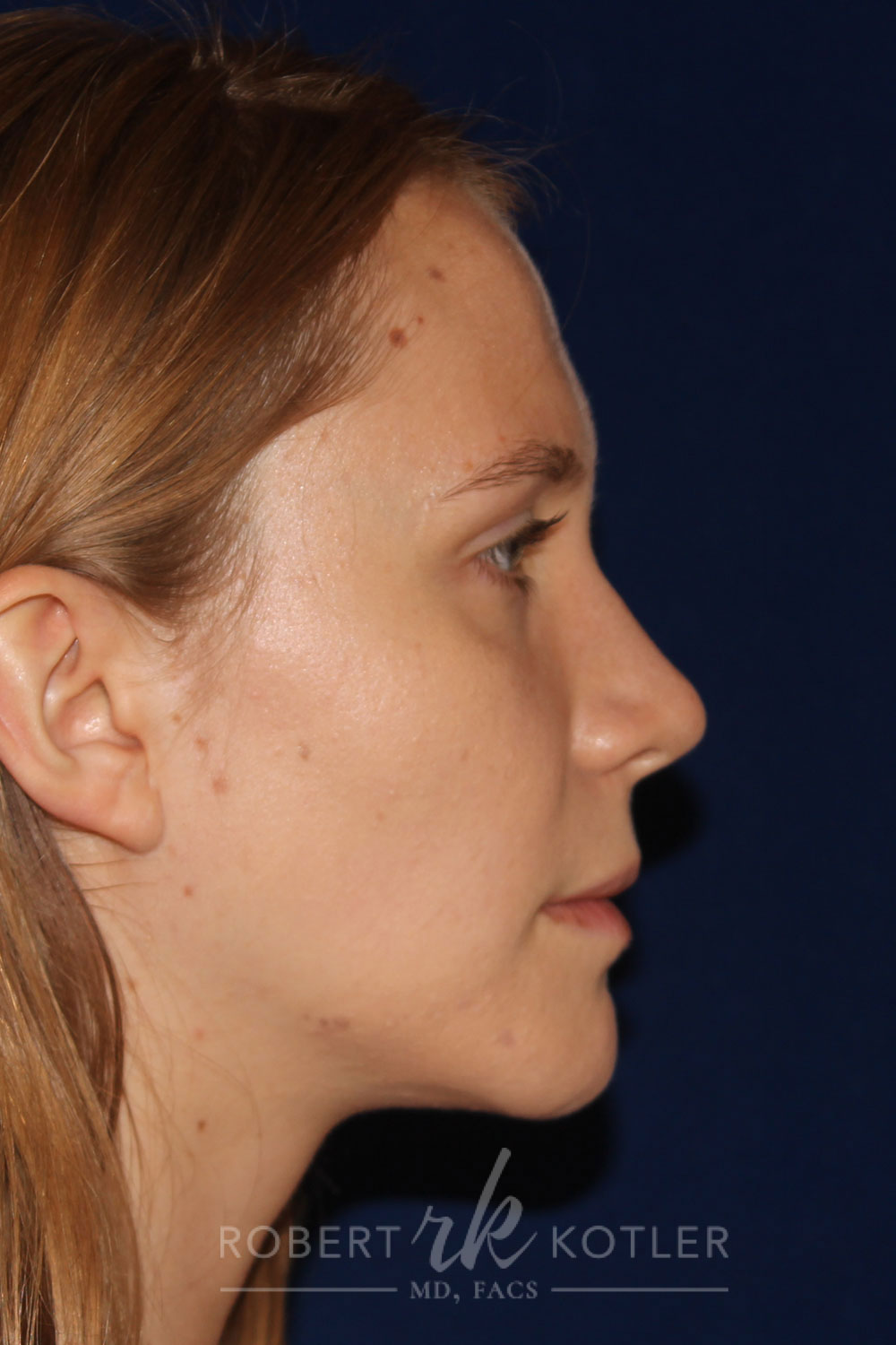 Rhinoplasty - Right Profile - After Pic - Narrowing of the nose - narrowing of bony and cartilaginous structure - Best Rhinoplasty Beverly Hills