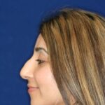 Closed Rhinoplasty - Bump removal - refined tip - slight elevation from lip - Left Profile - Before Pic - Top Rhinoplasty Surgeon