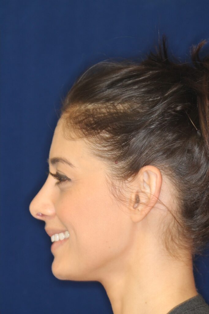 Closed Rhinoplasty - Lowering of the bridge and refine the tip - Left Profile Smile -After Pic - Best Nose Job Surgeon