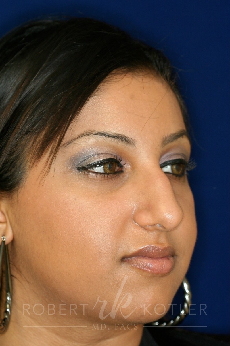 Closed Rhinoplasty - Right Profile - Before Pic - Hump removal - Tip refinement - Nose recessed closer to face - Best Nose Job Surgeon