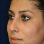 Closed Rhinoplasty - Left Angle Profile - After Pic - Hump removal - Tip refinement - Nose recessed closer to face - Best Rhinoplasty Beverly Hills