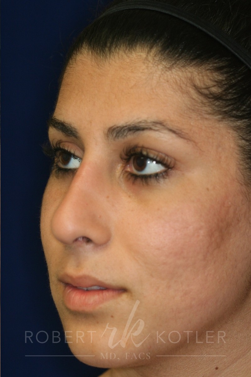 Closed Rhinoplasty - Left Angle Profile - After Pic - Hump removal - Tip refinement - Nose recessed closer to face - Best Rhinoplasty Beverly Hills