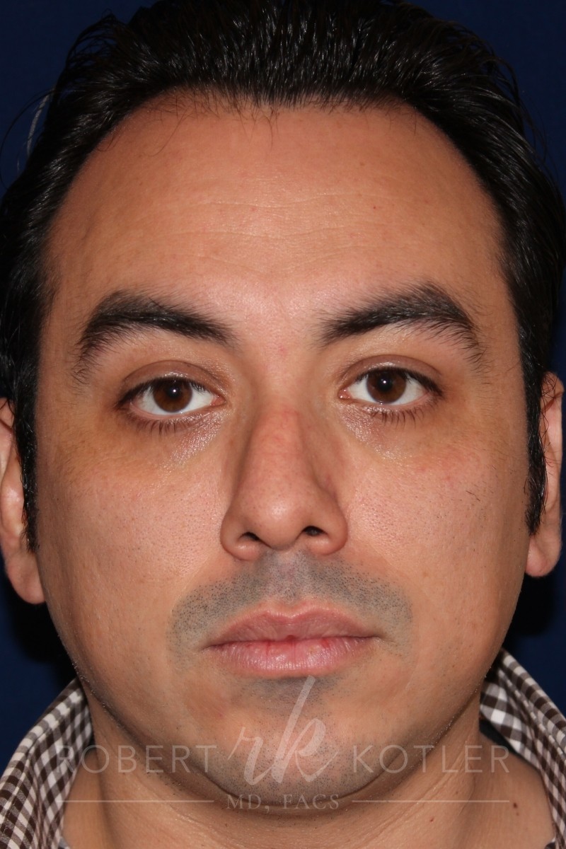 Rhinoplasty - Front face view - Before Pic - Correction of nasal fracture - Hump removal - Tip refinement - Crooked nose straightened - Best Nose Job Surgeon