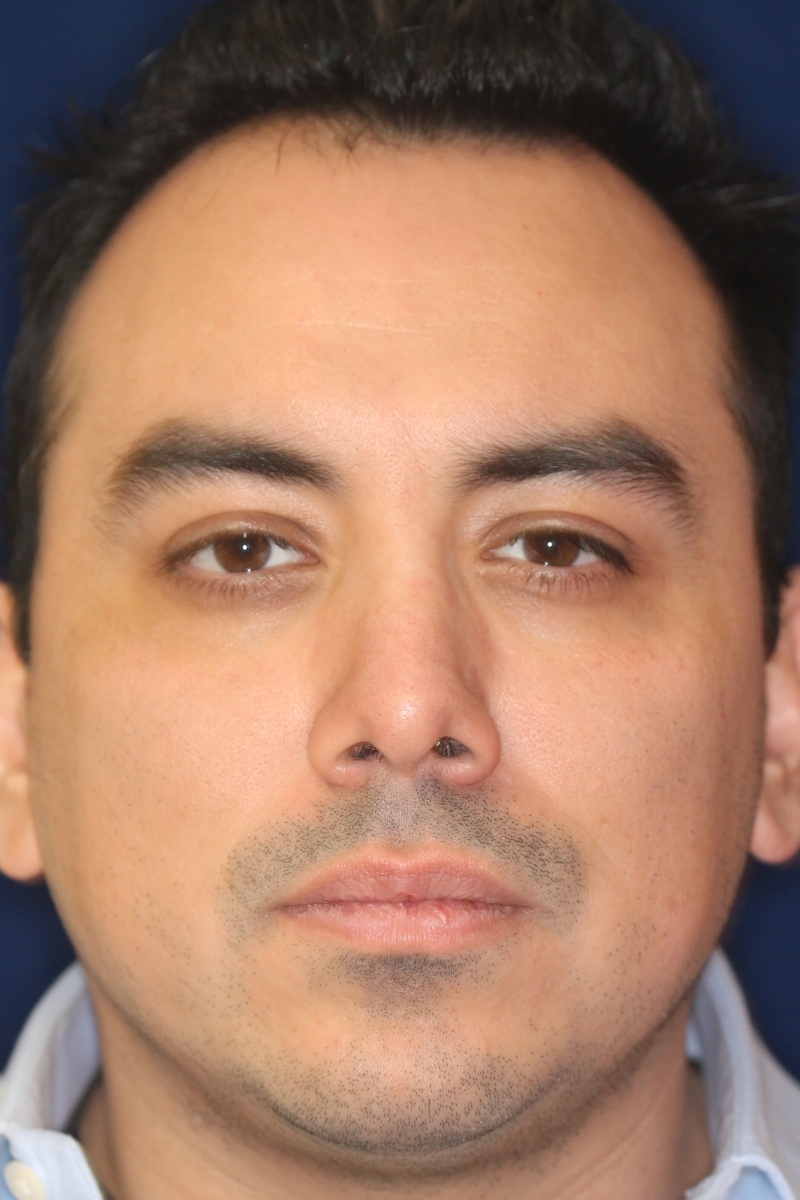 Rhinoplasty - Front face view -After Pic - Correction of nasal fracture - Hump removal - Tip refinement - Crooked nose straightened - Top Rhinoplasty Surgeon