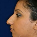 Closed Rhinoplasty - Left Profile - Before Pic - Hump removal - Tip refinement - Nose recessed closer to face - Beverly Hills Rhinoplasty Superspecialist