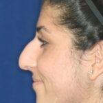 Closed Rhinoplasty - Left Profile -Before Pic - Hump removal - Tip refinement - Nose recessed closer to face - Rhinoplasty Surgeon in Beverly Hills
