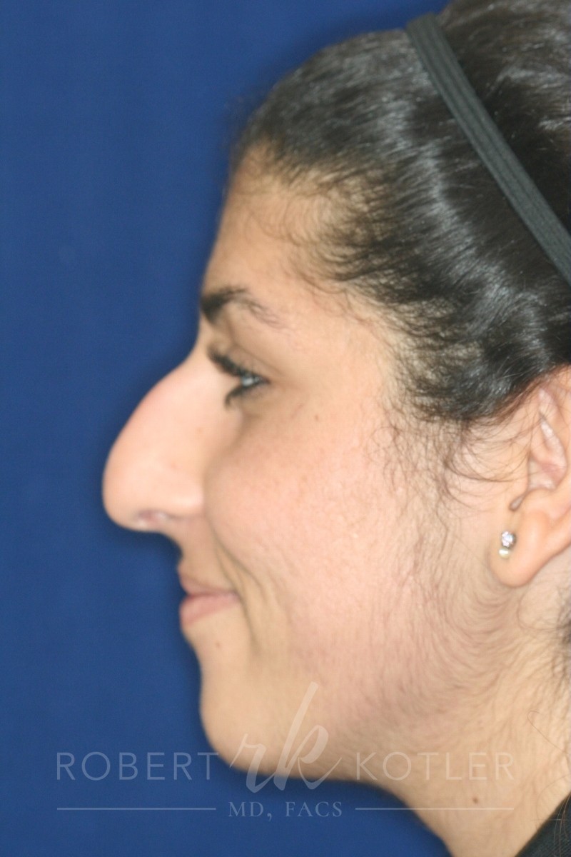 Closed Rhinoplasty - Left Profile -Before Pic - Hump removal - Tip refinement - Nose recessed closer to face - Rhinoplasty Surgeon in Beverly Hills
