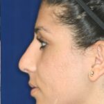 Closed Rhinoplasty - Left Profile -After Pic - Hump removal - Tip refinement - Nose recessed closer to face - Nose Job in Beverly Hills