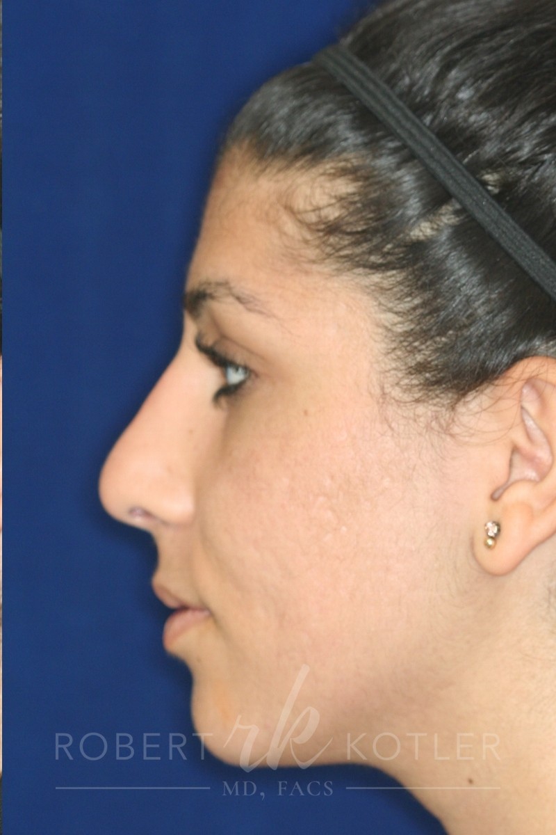 Closed Rhinoplasty - Left Profile -After Pic - Hump removal - Tip refinement - Nose recessed closer to face - Nose Job in Beverly Hills