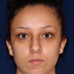 Closed Rhinoplasty - Front Face View - Before Pic - Hump removal - Tip refinement - Elevation from the lip - Lip recessed - Rhinoplasty Surgeon in Beverly Hills