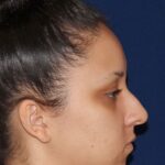 Closed Rhinoplasty - Right Profile - Before Pic - Hump removal - Tip refinement - Elevation from the lip - Beverly Hills Rhinoplasty Superspecialist