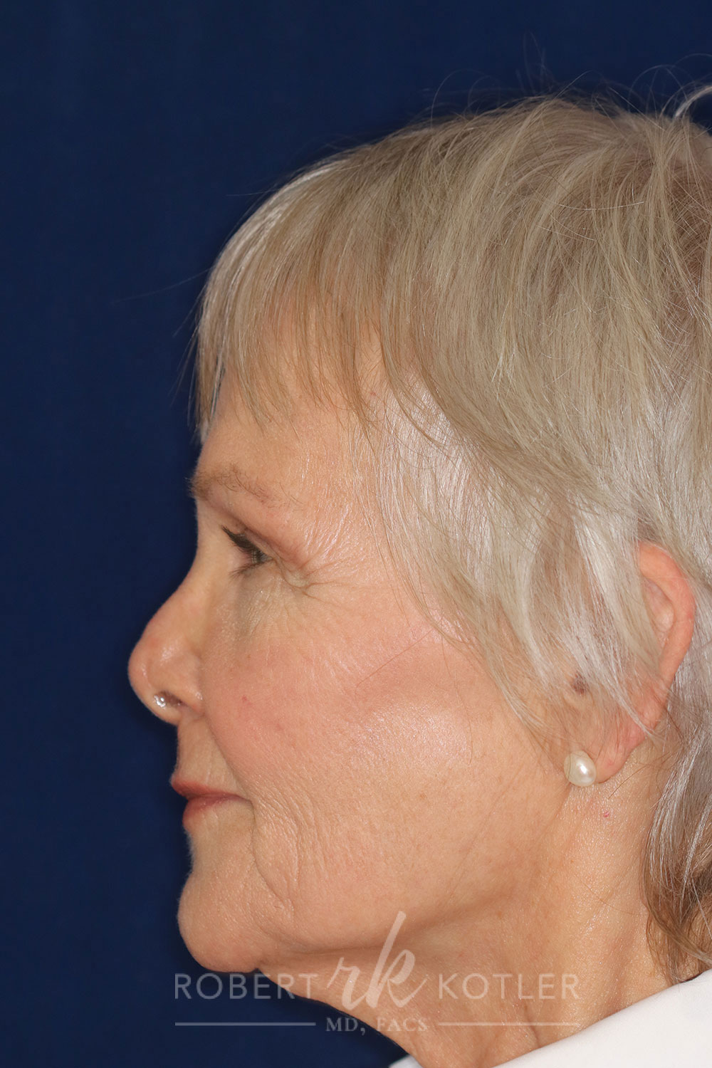 Permanent Non-surgical Revision Rhinoplasty - Left Profile - Before Pic - Hump concealed - Nose tip restored - Nose looks natural - Nose Job in Beverly Hills