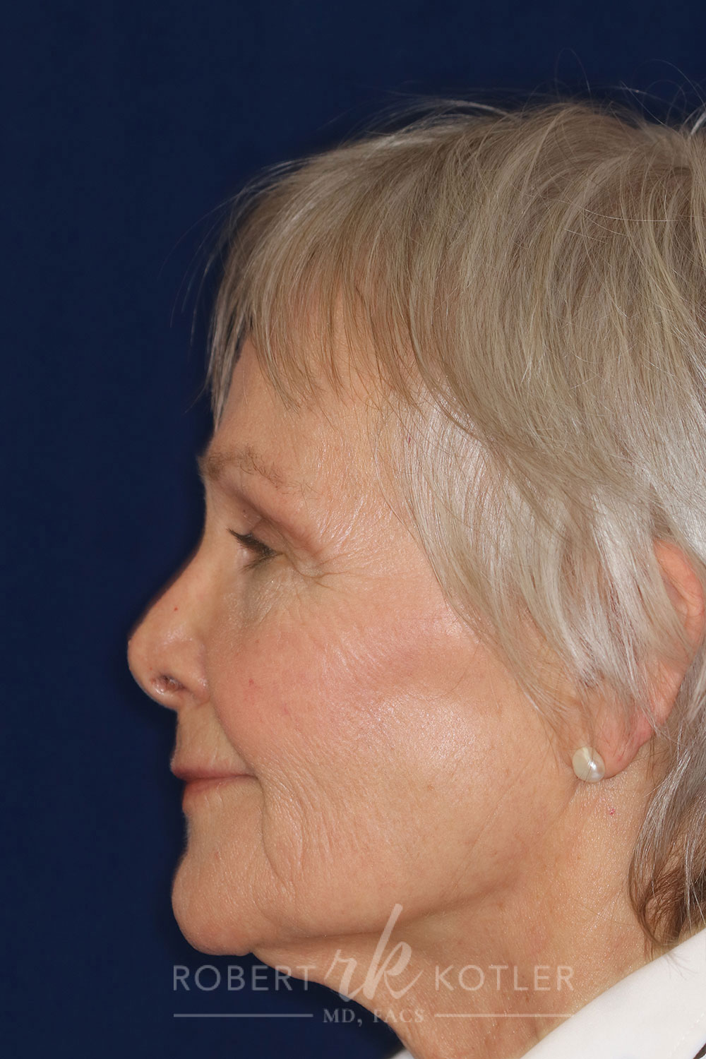 Permanent Non-surgical Revision Rhinoplasty - Left Profile - After Pic - Hump concealed - Nose tip restored - Nose looks natural - Best Nose Job Surgeon