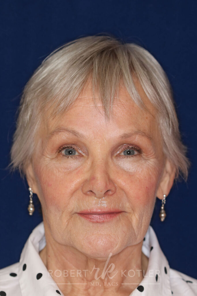Permanent Non-surgical Revision Rhinoplasty - Front Face view - Before Pic - Hump concealed - Nose tip restored - Nose looks natural - Best Rhinoplasty Beverly Hills