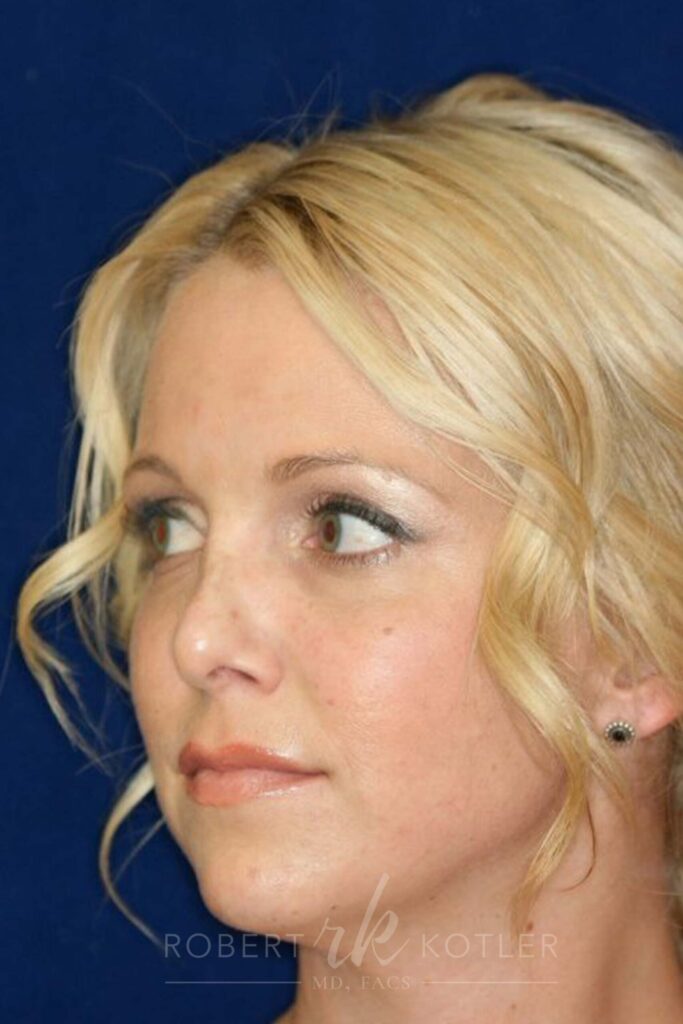 Permanent Non-surgical Revision Rhinoplasty - Left Profile - Before Pic - Crooked nose correction - Tissue loss concealed - Cartilage graft concealed - Best Rhinoplasty Beverly Hills