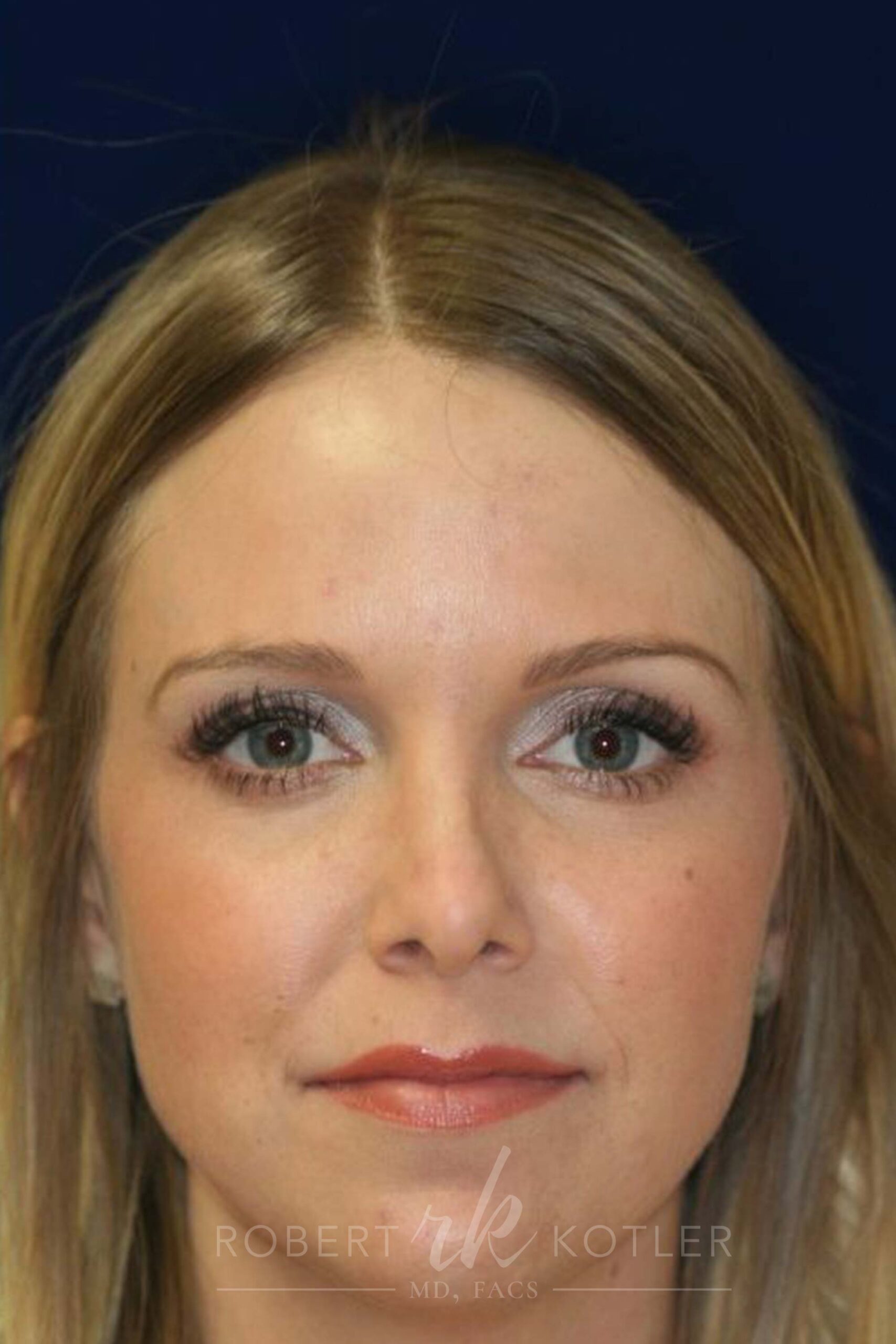 Permanent Non-surgical Revision Rhinoplasty - Front Face View - After Pic - Crooked nose correction - Tissue loss concealed - Cartilage graft concealed - Beverly Hills Rhinoplasty Superspecialist