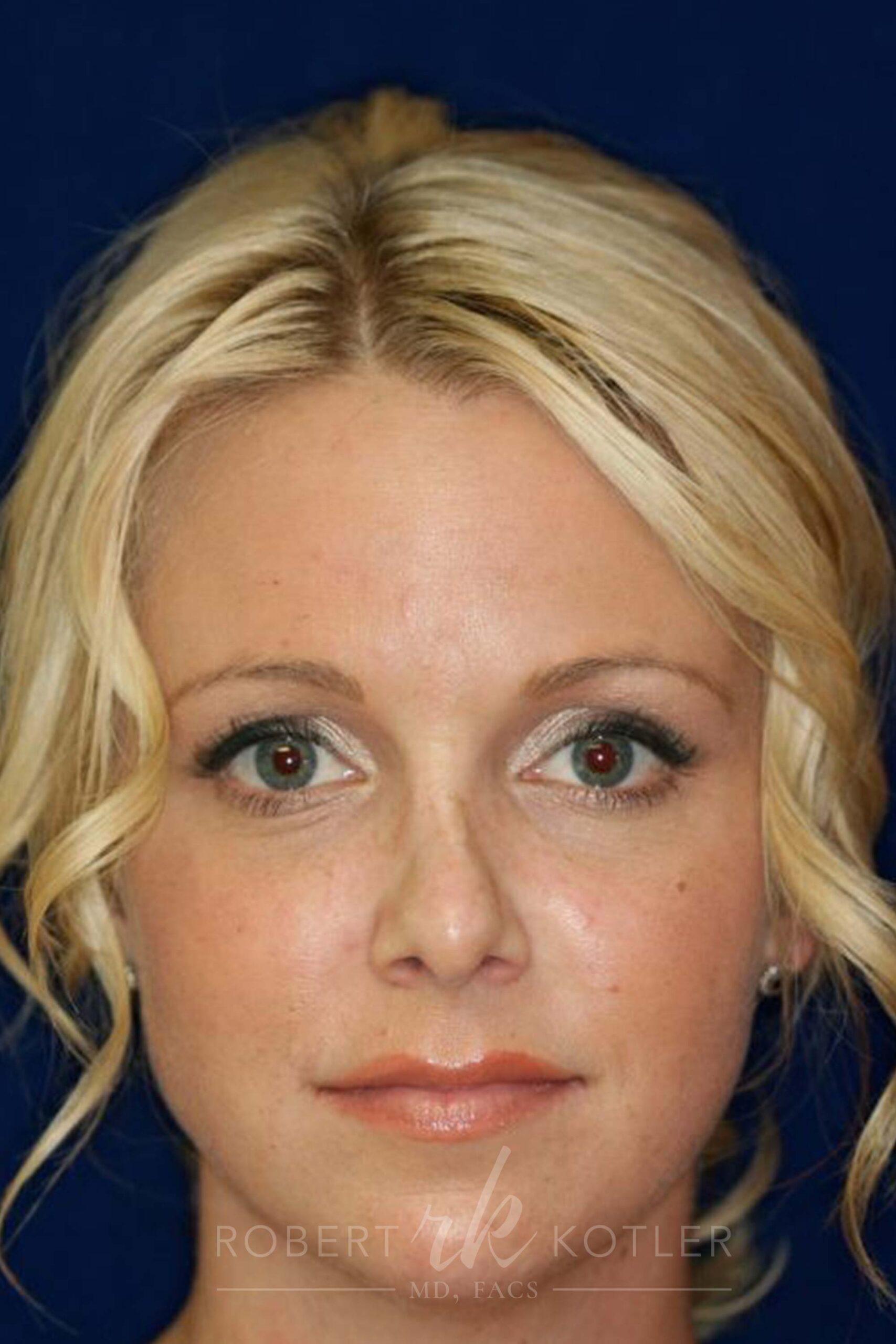 Permanent Non-surgical Revision Rhinoplasty - Front Face View - Before Pic - Crooked nose correction - Tissue loss concealed - Cartilage graft concealed - Top Rhinoplasty Surgeon