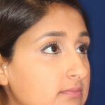 Closed Rhinoplasty - Front Right angle view -Before Pic - Removal of hump and nose tip refined - Rhinoplasty Surgeon in Beverly Hills