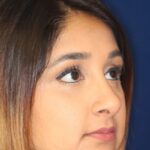 Closed Rhinoplasty - Front Right angle view -After Pic - Removal of hump and nose tip refined -Nose Job in Beverly Hills