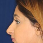 Closed Rhinoplasty - Left Profile - After Pic - Removal of hump and nose tip refined - Top Rhinoplasty Surgeon