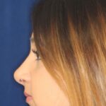 Closed Rhinoplasty - Left Profile - After Pic - Straightening of a very crooked nose with tip refinement - Top Rhinoplasty Surgeon