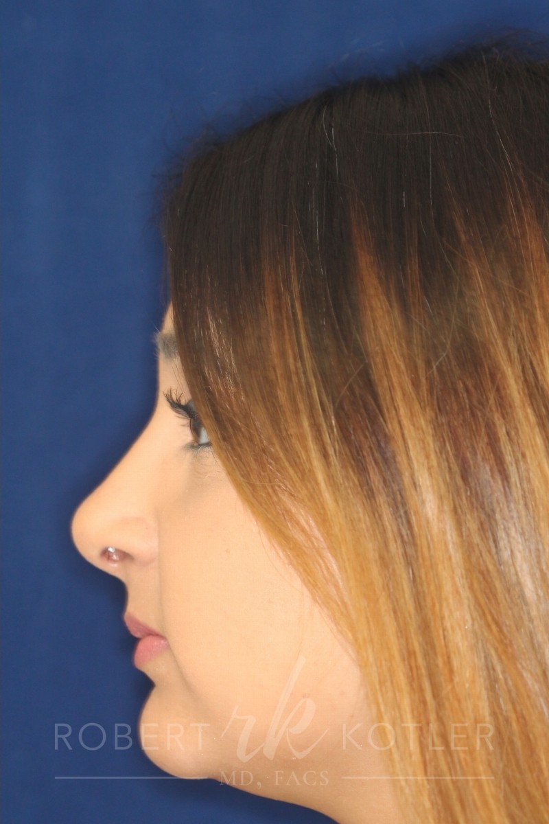 Closed Rhinoplasty - Left Profile - After Pic - Straightening of a very crooked nose with tip refinement - Top Rhinoplasty Surgeon