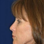 Closed Rhinoplasty - Left Profile - After Pic - Straightening of a very crooked nose with tip refinement - Top Rhinoplasty Surgeon