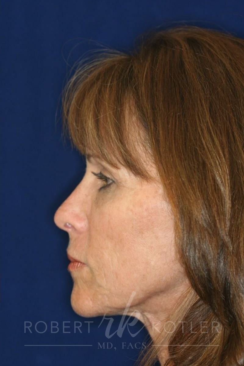 Closed Rhinoplasty - Left Profile - After Pic - Straightening of a very crooked nose with tip refinement - Top Rhinoplasty Surgeon