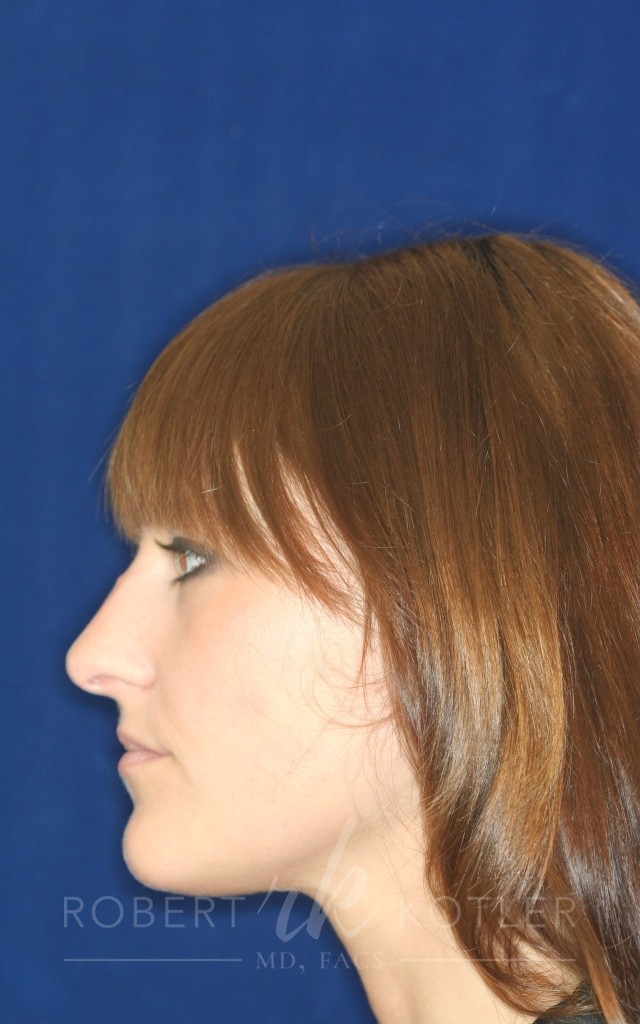 Closed Rhinoplasty - Left Profile - Before Pic - Hump removal - Nose tip refinement - Beverly Hills Rhinoplasty Superspecialist