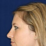 Closed Rhinoplasty - Left Profile - After Pic - Hump removal - Nose tip refinement - Best Rhinoplasty Beverly Hills