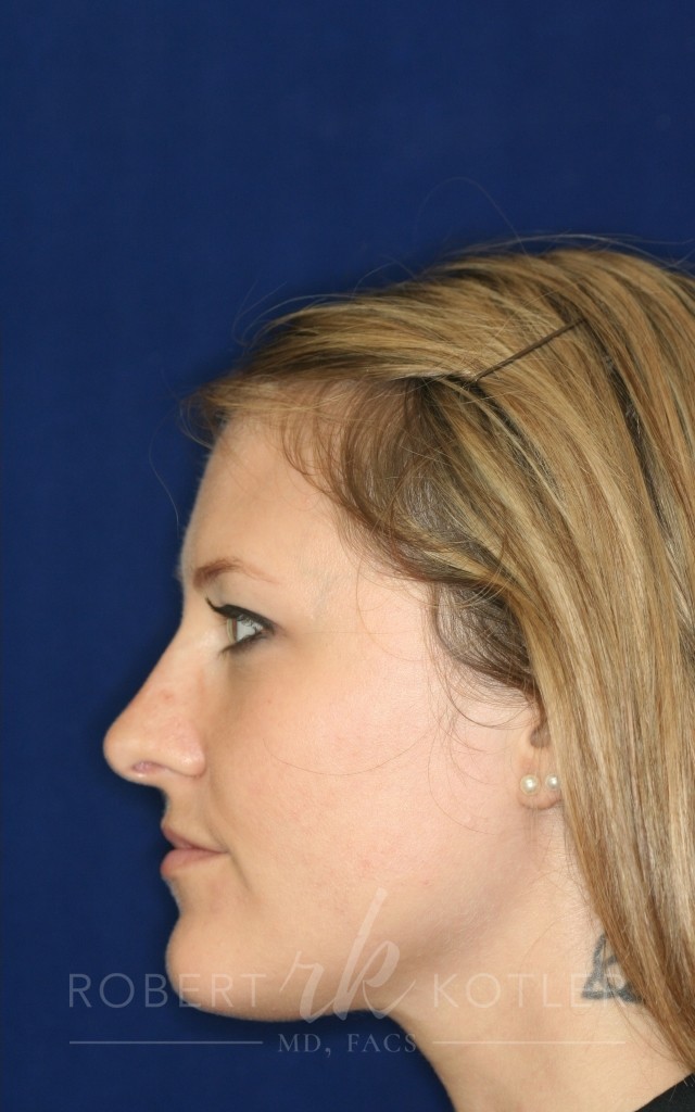 Closed Rhinoplasty - Left Profile - After Pic - Hump removal - Nose tip refinement - Best Rhinoplasty Beverly Hills