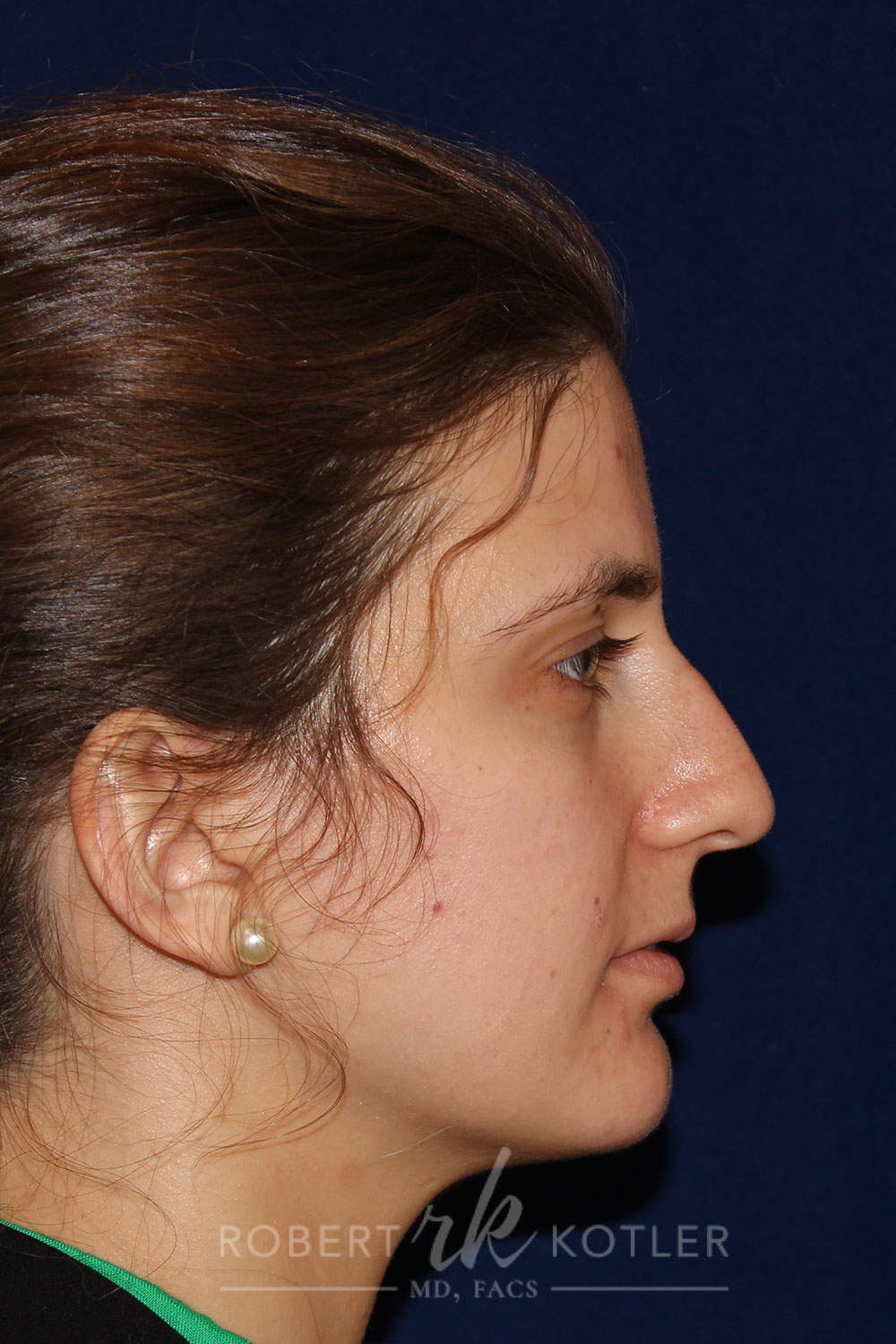 Closed Rhinoplasty - Right Profile - Before Pic - Hump removal - tip refinement - nose tip elevation - Beverly Hills Rhinoplasty Superspecialist